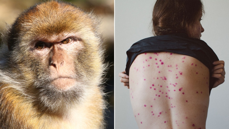 Viruela del Mono en Argentina: comunicado del Ministerio de Salud