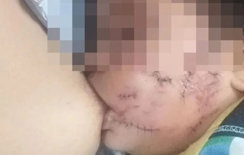 Jujuy: Una beba fue atacada por un pitbull
