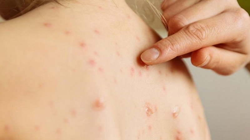 Salta: detectan un probable caso de sarampión y recomiendan vacunarse