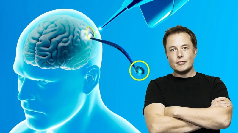 Neurólogos con dudas tras el anuncio de Musk sobre el implante de chips cerebrales